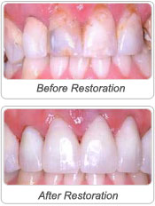 Dental Crowns and Caps before and after image