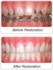 Prosthodontic restoration image