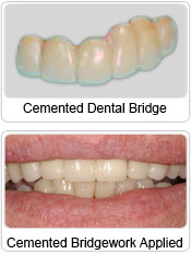 Cemented Dental Bridge