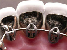 Orthodontic sub lingual braces
